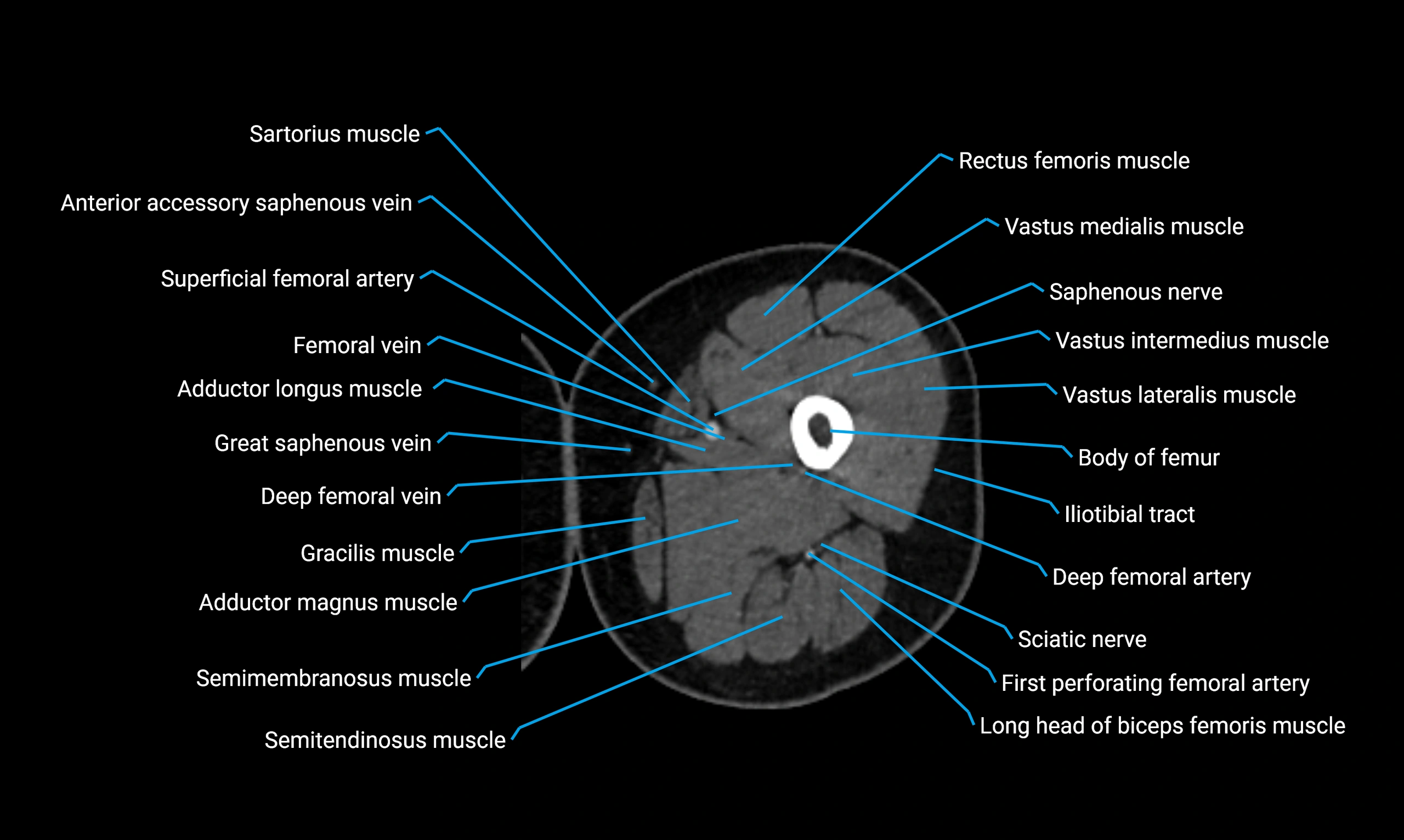CT lower limb axial cross sectional anatomy labelled image 46 (2).webp